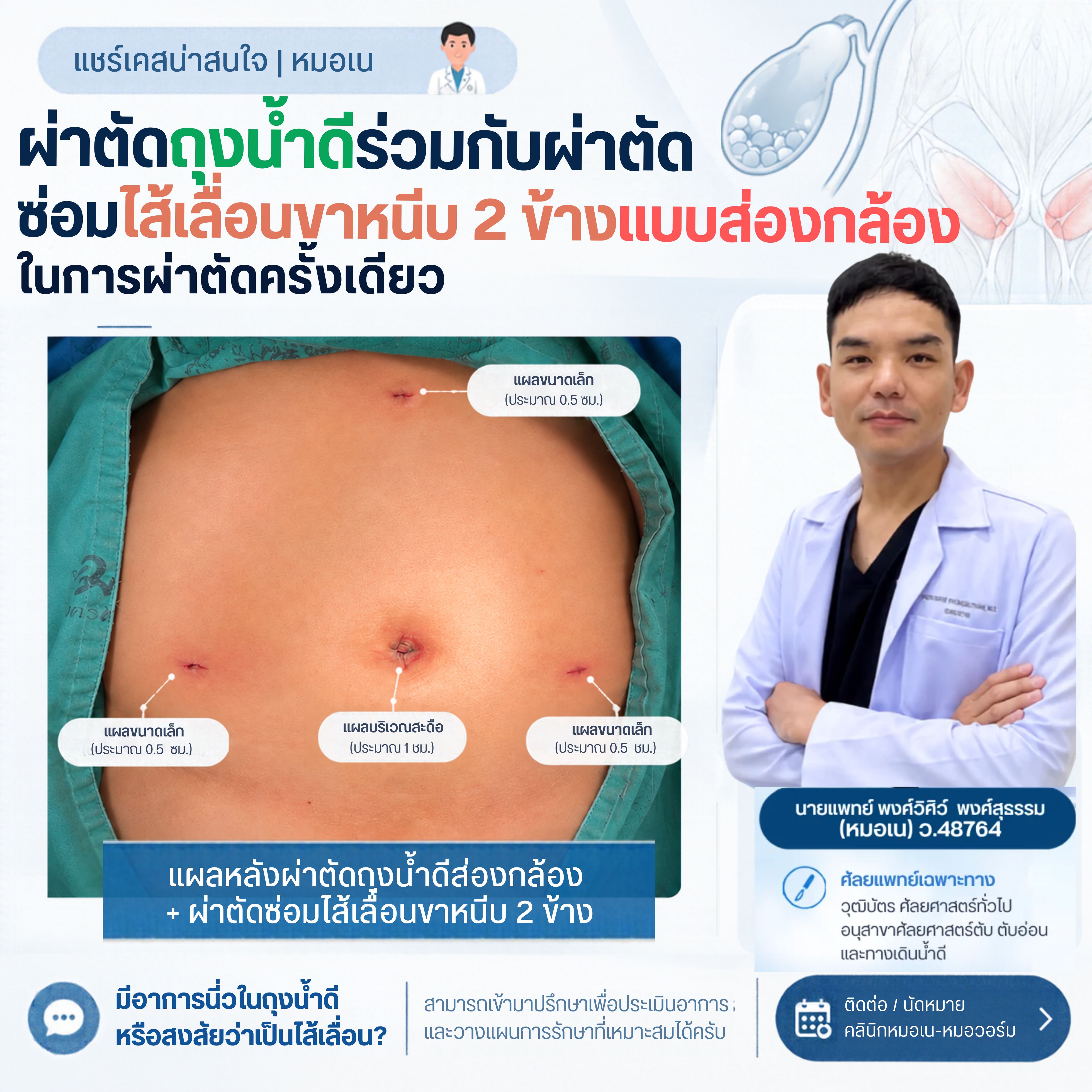 ผ่าตัดถุงน้ำดีส่องกล้อง ร่วมกับผ่าตัดซ่อมไส้เลื่อนขาหนีบ 2 ข้าง ในการผ่าตัดครั้งเดียว