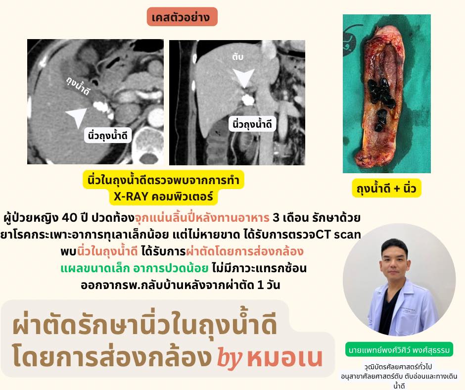  ผ่าตัดรักษานิ่วในถุงน้ำดีด้วยการส่องกล้อง (แผลเล็ก ฟื้นตัวไว) 